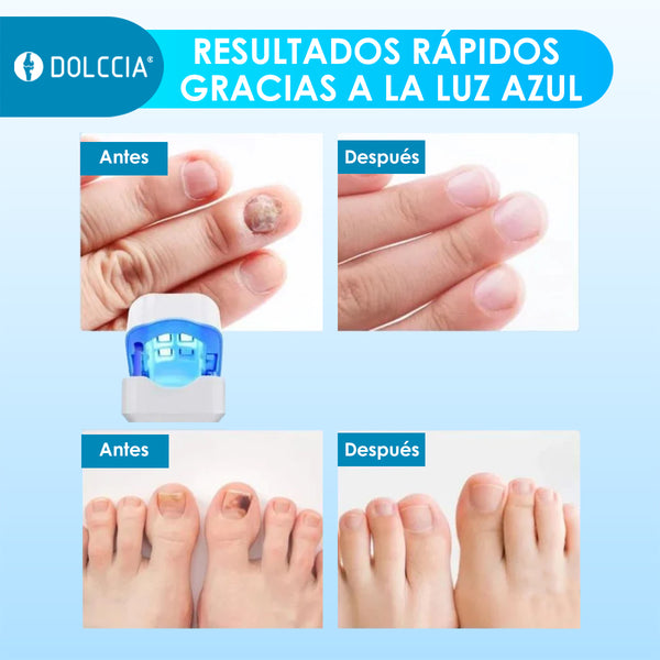 Tratamiento Láser - HongoMax™ [RESTAURA UÑAS]